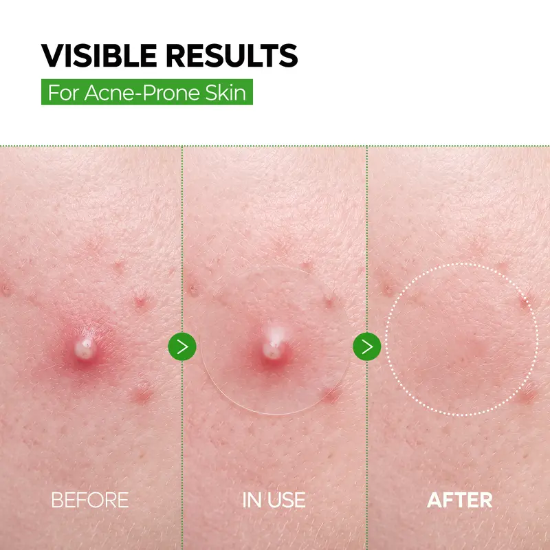 Zero-Fit Blemish & Dark Spot Patch Duo (144 Patches)