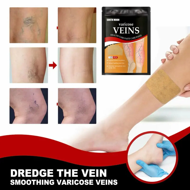 Buy 1 Get 1 Free 🔥 Varicose Vein Relief Patches