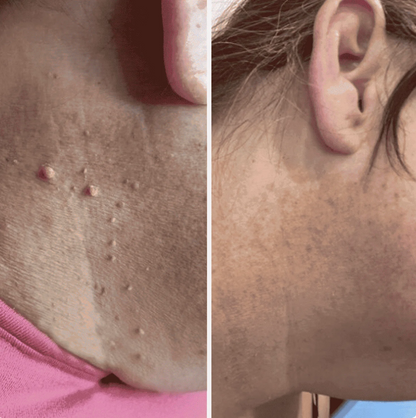 Painless Skin Tag Removal Kit - Safely Remove Skin Tags at Home