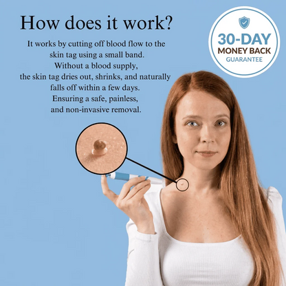 Painless Skin Tag Removal Kit - Safely Remove Skin Tags at Home