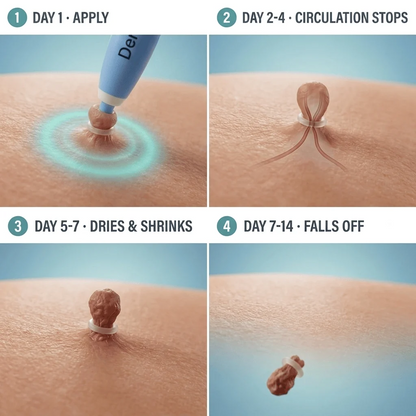 Painless Skin Tag Removal Kit - Safely Remove Skin Tags at Home