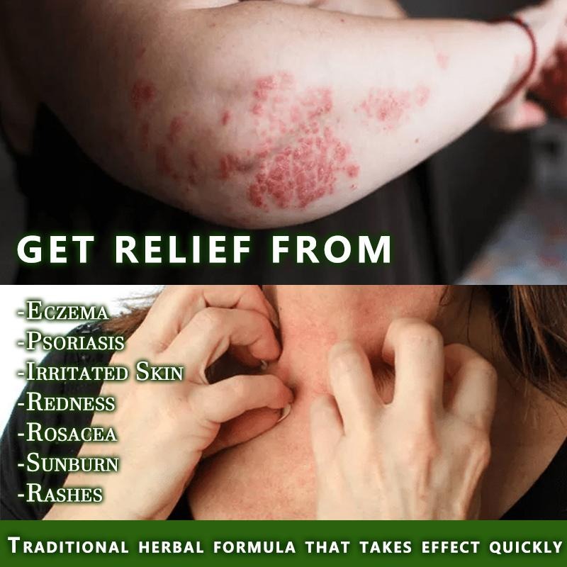 Natural Soothing & Relief Cream for Eczema – Honeysuckle & Peppermint, Gentle for All Ages