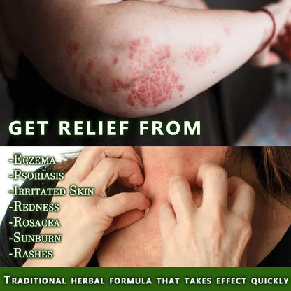 Natural Soothing & Relief Cream for Eczema – Honeysuckle & Peppermint, Gentle for All Ages