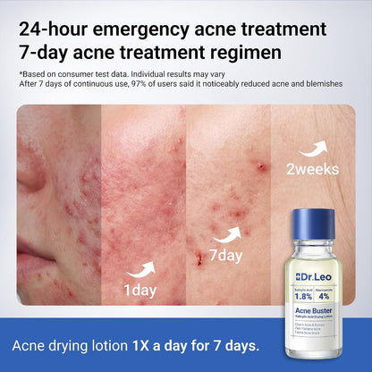 Drying Lotion Acne Spot Treatment – 1.8% Salicylic Acid