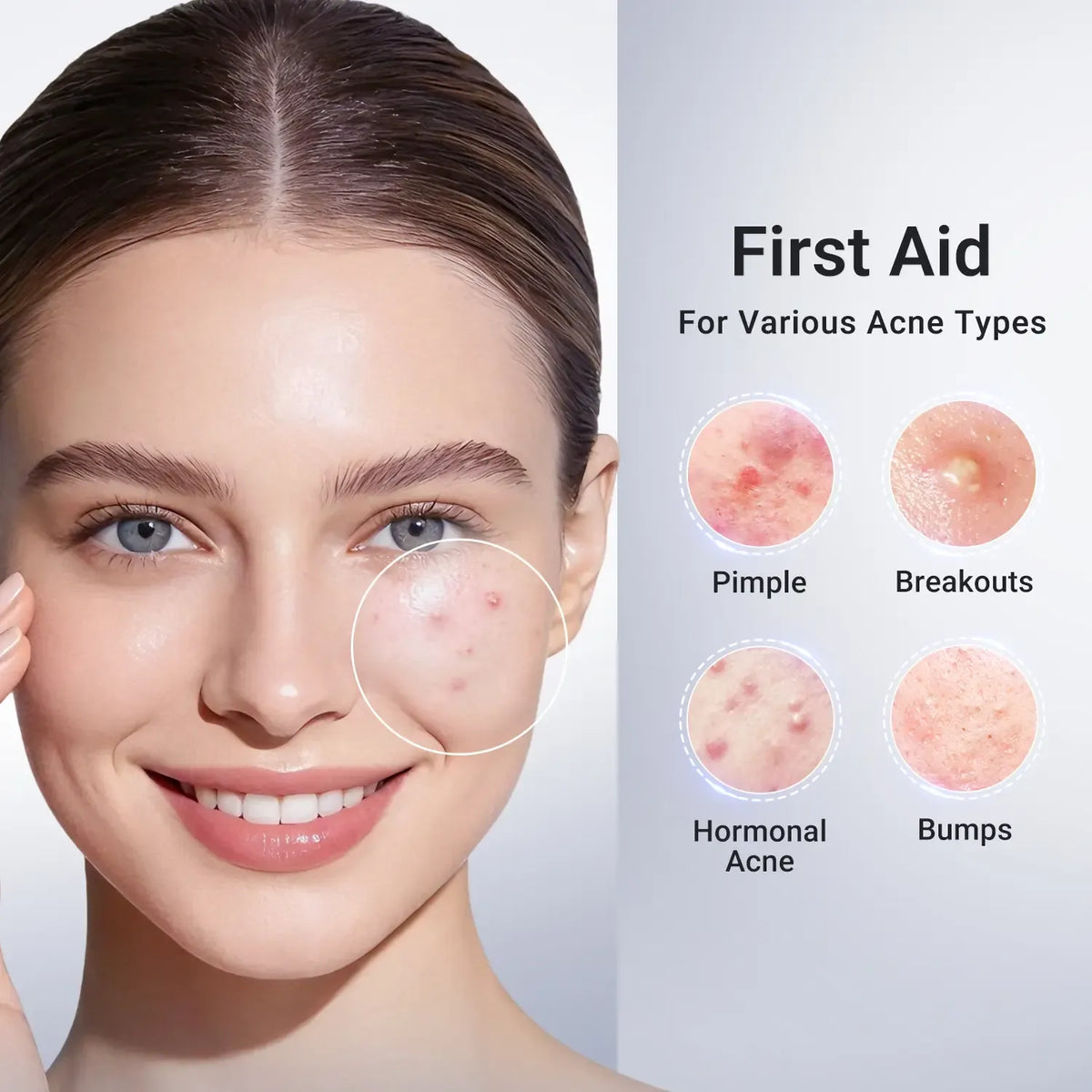 Drying Lotion Acne Spot Treatment – 1.8% Salicylic Acid