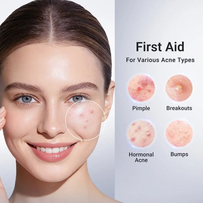 Drying Lotion Acne Spot Treatment – 1.8% Salicylic Acid