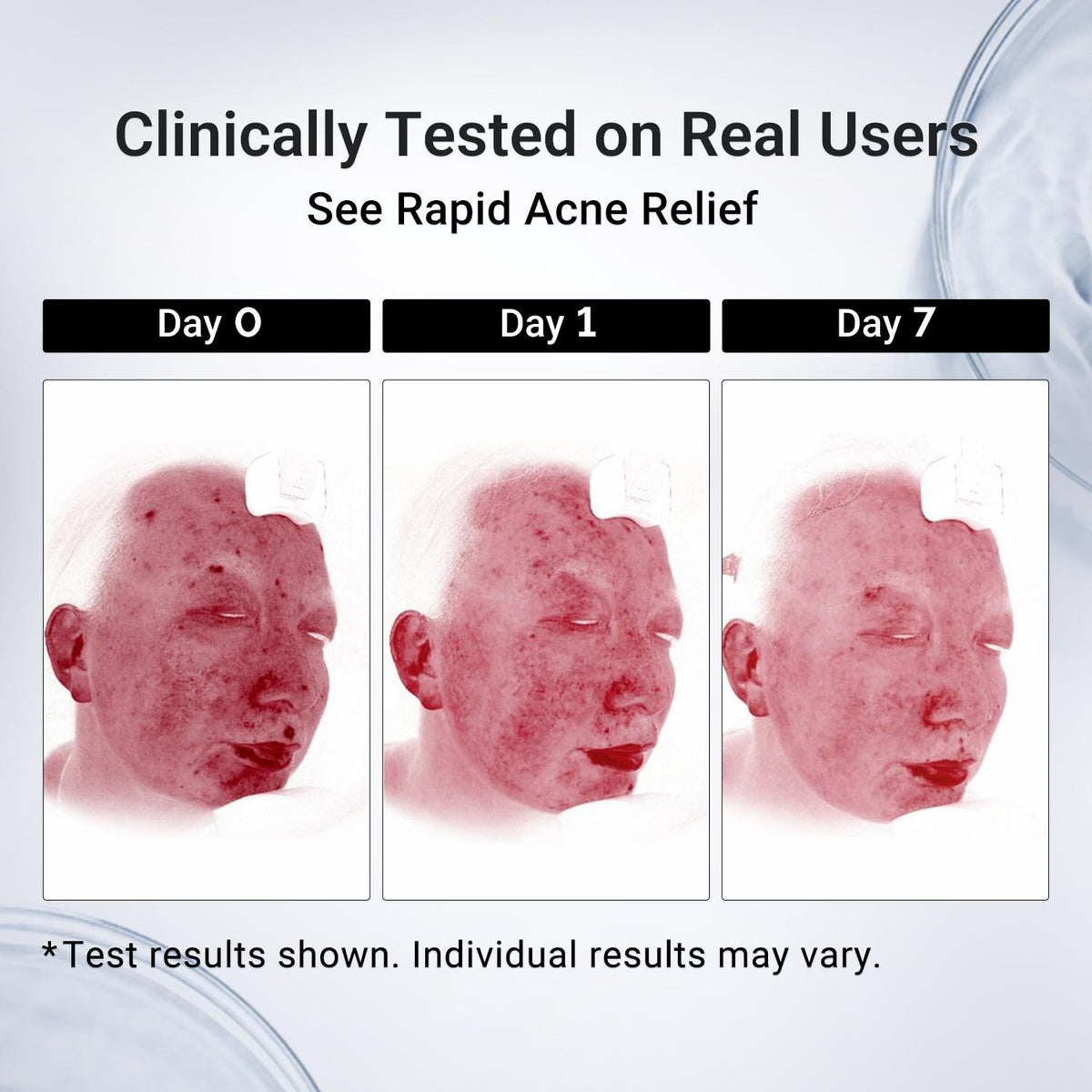 Drying Lotion Acne Spot Treatment – 1.8% Salicylic Acid