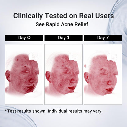 Drying Lotion Acne Spot Treatment – 1.8% Salicylic Acid