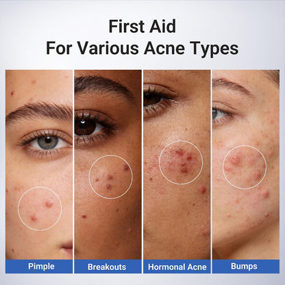 Drying Lotion Acne Spot Treatment – 1.8% Salicylic Acid