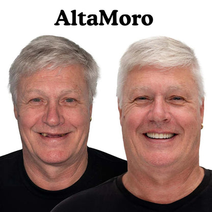 Custom-Fit Instant Smile Dentures – Natural Looking Comfort Fit