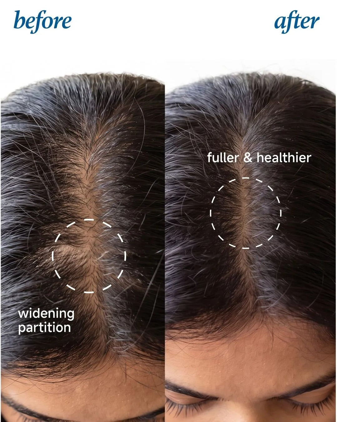 Rosemary Hair Growth Serum Roll-On – 3% Rosemary, 3% Redensyl & 2% Anagain