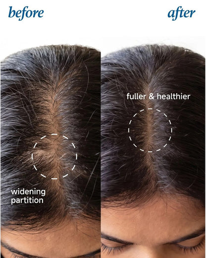 Rosemary Hair Growth Serum Roll-On – 3% Rosemary, 3% Redensyl & 2% Anagain